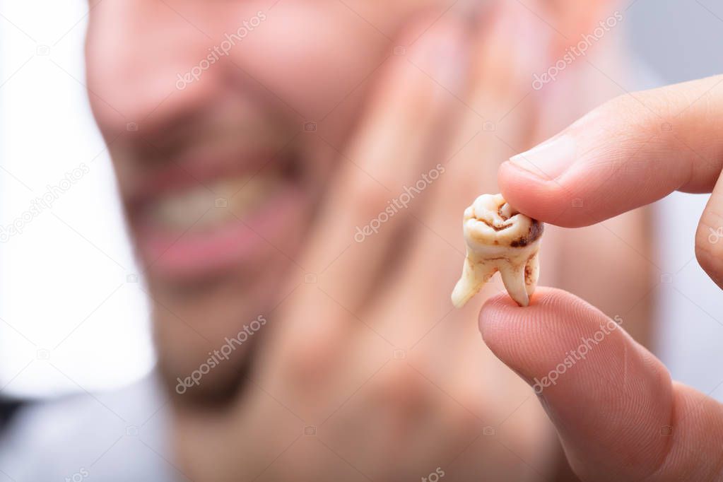 Close-up Of A Man's Hand Holding Decayed Tooth