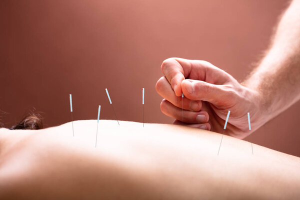 Close-up Of Therapist Hand Performing Acupuncture Therapy On Woman's Back In Spa