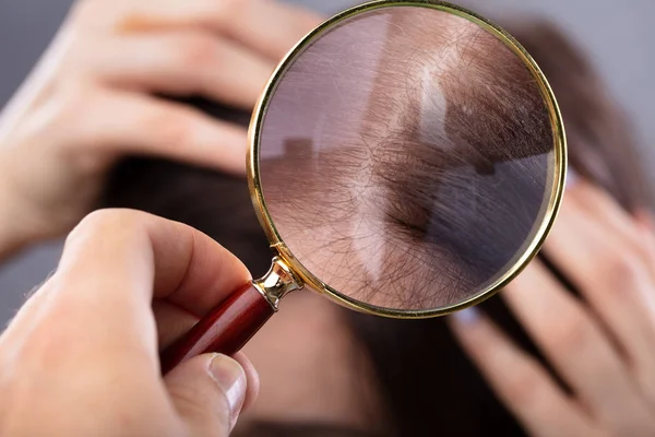 Main Dermatologue Examinant Les Cheveux Femme Avec Verre Grossissant — Photo