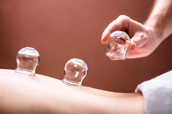 Primer Plano Terapeuta Masculino Colocando Tazas Vidrio Transparente Espalda Mujer —  Fotos de Stock