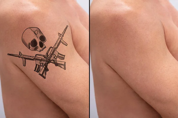 Shirtless Man Showing Before And After Laser Tattoo Removal Treatment On Arms