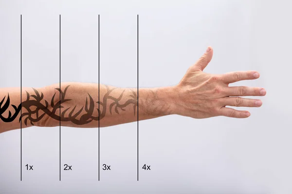 Rimozione Del Tatuaggio Laser Sulla Mano Dell Uomo Sullo Sfondo — Foto Stock