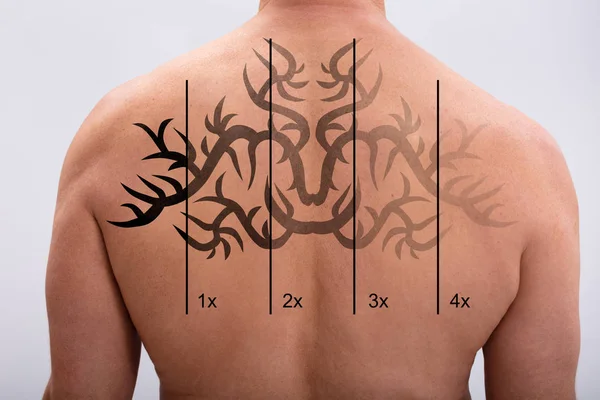 Vista Posteriore Uomo Con Rimozione Del Tatuaggio Laser Sfondo Bianco — Foto Stock
