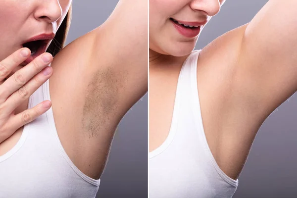 Concept Woman Underarm Hair Removal Grey Background — Stock Photo, Image