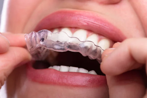 Close Mão Uma Mulher Colocando Alinhador Transparente Nos Dentes — Fotografia de Stock