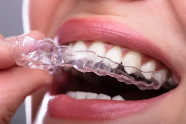 Close Woman Hand Putting Transparent Aligner Teeth — Stock Photo, Image