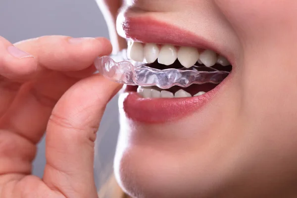 Woman Putting Transparent Aligner Teeth
