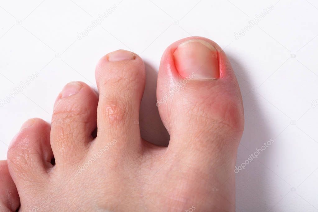 An Elevated View Of Sore Toe Nail On Floor