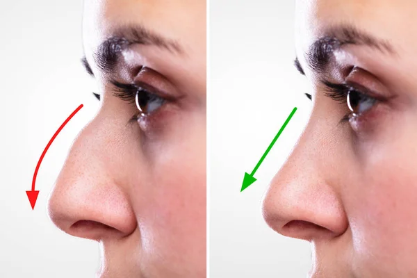 红绿箭整形手术前后妇女的鼻腔 — 图库照片
