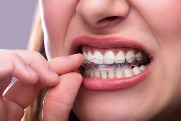 Close-up Of A Woman's Hand Putting Transparent Aligner In Teeth