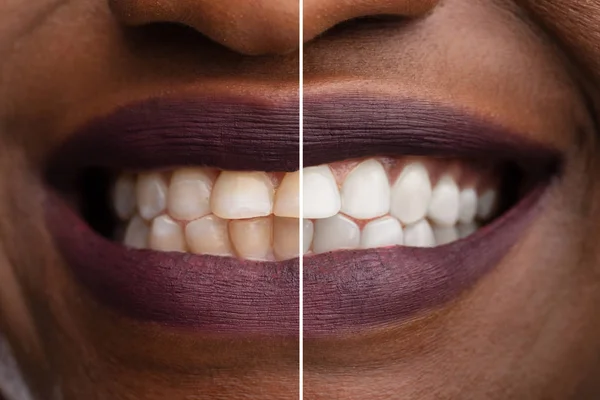 Close Dos Dentes Uma Mulher Sorridente Antes Depois Clareamento — Fotografia de Stock