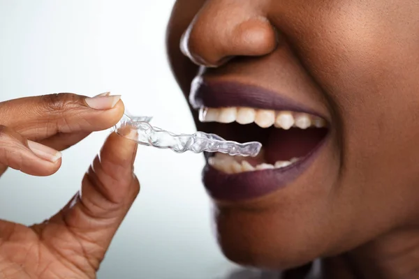 Close Mão Uma Mulher Colocando Alinhador Transparente Nos Dentes — Fotografia de Stock