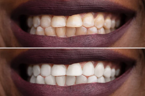 Primer Plano Los Dientes Una Mujer Sonriente Antes Después Del — Foto de Stock