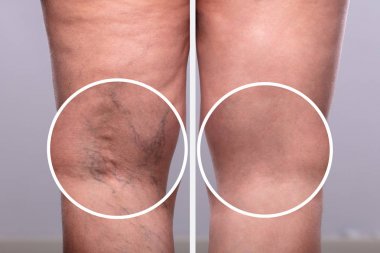 A Person Knee's With Varicose Veins And Capillaries Before And After Medical Treatment clipart