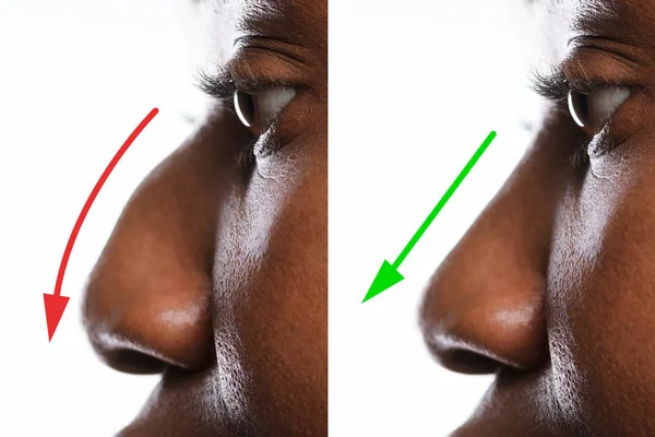 Женский Нос После Пластической Хирургии Красными Зелеными Стрелами — стоковое фото