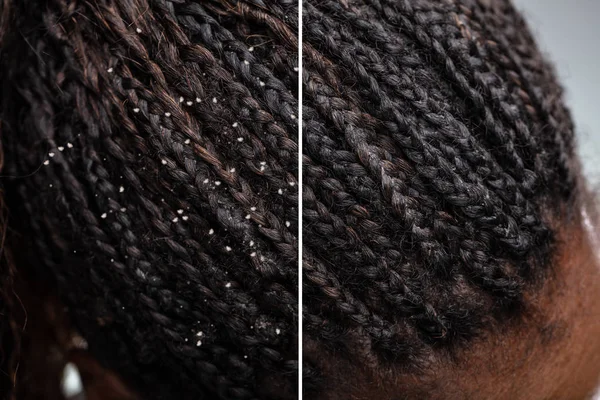 Διαφορά Των Μαλλιών Πιτυρίδα Και Καθαρά Μαλλιά — Φωτογραφία Αρχείου