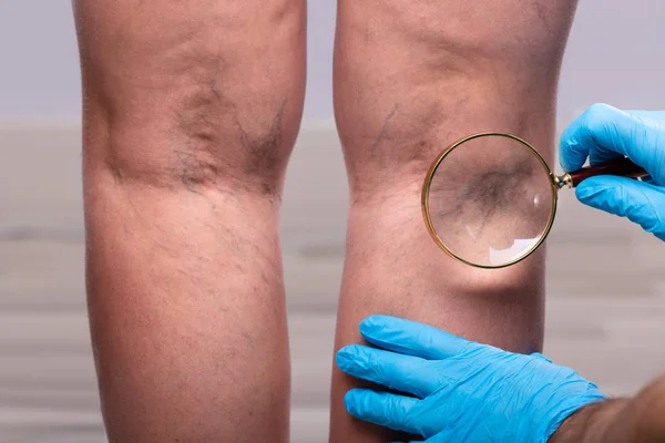 Närbild Kirurg Bär Blå Kirurgiska Handskar Undersöka Åderbråck Genom Förstoringsglas — Stockfoto