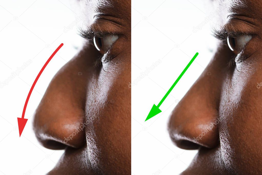 Woman's Nose Before And After Plastic Surgery With Red And Green Arrows