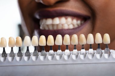 Implant diş gölge eşleştirme mutlu bir kadın Close-up
