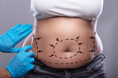 Close-up Of Surgeon Hand In Blue Glove Holding Scalpel On Woman's Belly Marked With Lines clipart