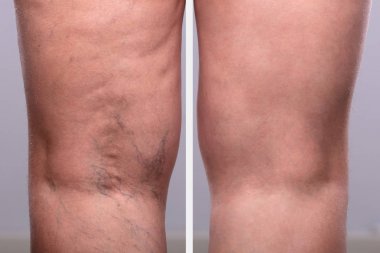 A Person Knee's With Varicose Veins And Capillaries Before And After Medical Treatment clipart