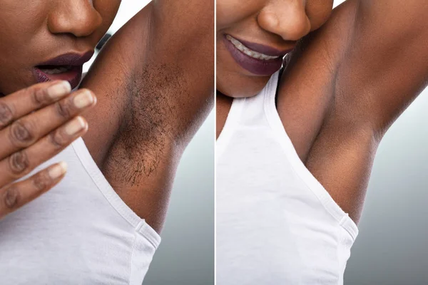 Concept Woman Underarm Hair Removal Grey Background — Stock Photo, Image