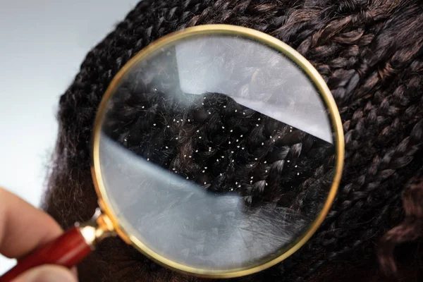 Close Dandruff Black Hair Seen Magnifying Glass — Stock Photo, Image