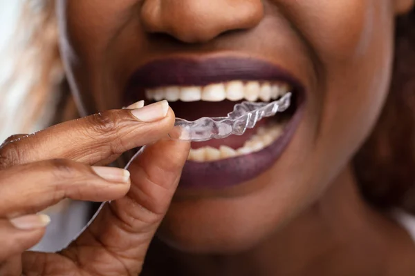 Крупный План Женской Руки Помещающей Прозрачного Выравнивателя Зубы — стоковое фото