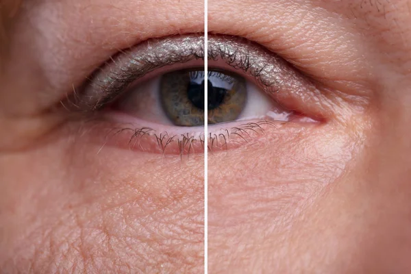 Close Sacos Olhos Mulher Antes Depois Tratamento Cosmético — Fotografia de Stock