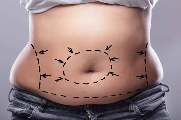 Nahaufnahme Des Übergewichtigen Weiblichen Körpers Mit Aufgemalten Linien Und Pfeilen — Stockfoto