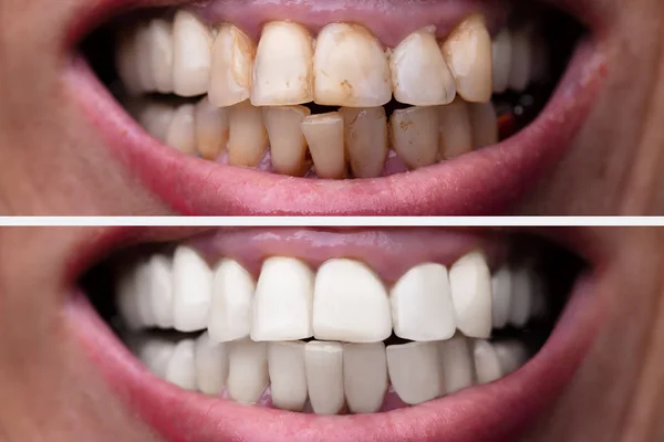 牙科治疗前后的女性牙齿 — 图库照片