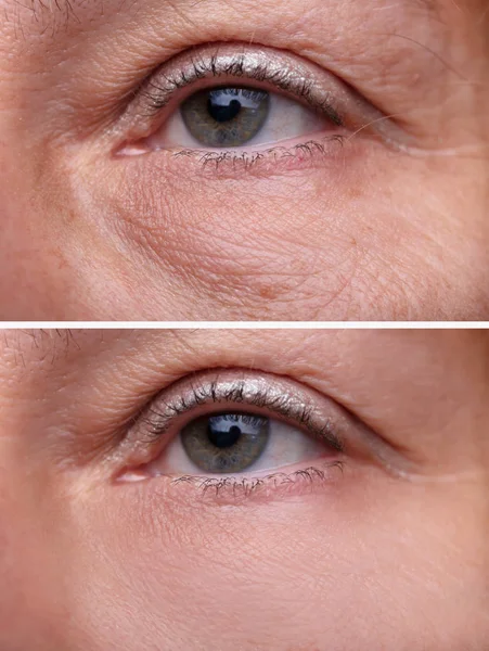 Close Sacos Olhos Mulher Antes Depois Tratamento Cosmético — Fotografia de Stock