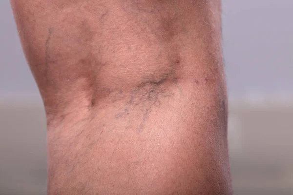 Close Varicose Veins Person Leg Blurred Background — Stock Photo, Image