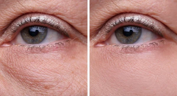 Yakın Çekim Kadın Göz Çantaları Önce Sonra Kozmetik Tedavi — Stok fotoğraf