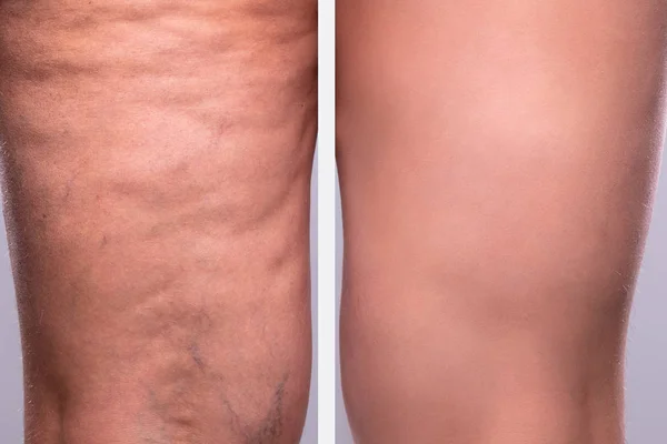 Selülitli Olmayan Bir Kişinin Bacaklarının Uyluklarının Karşılaştırılması — Stok fotoğraf