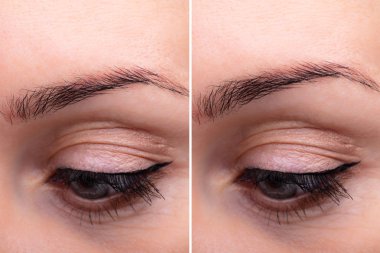 Endoskopik Kaş Kaldırma İşlemi Öncesi ve Sonrası