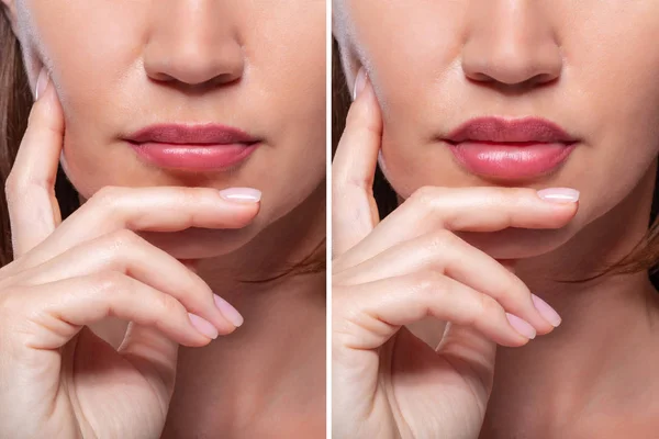 Mulher Antes Depois Dos Lábios Procedimento Aumento — Fotografia de Stock