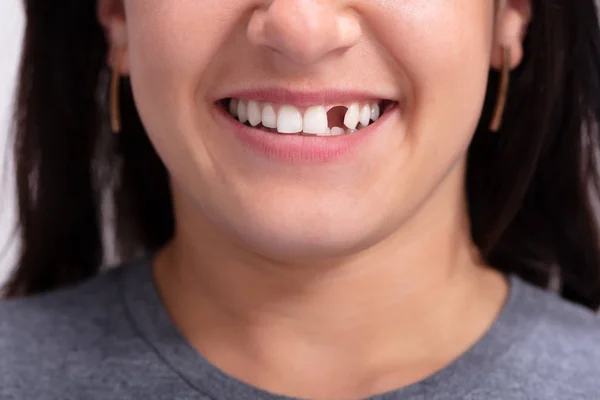 Fechar Foto Jovem Mulher Com Dente Desaparecido — Fotografia de Stock