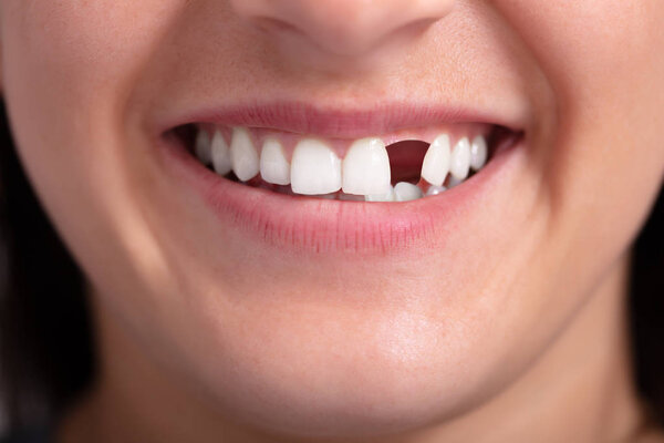 Close Up Photo Of Young Woman With Missing Tooth