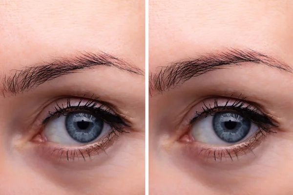 Endoscopic Eyebrow Lifting Procedure — Stock Photo, Image