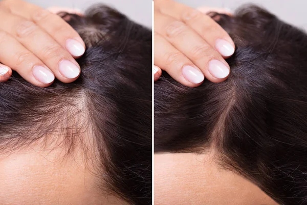 Frau Vor Und Nach Der Behandlung Von Haarausfall — Stockfoto
