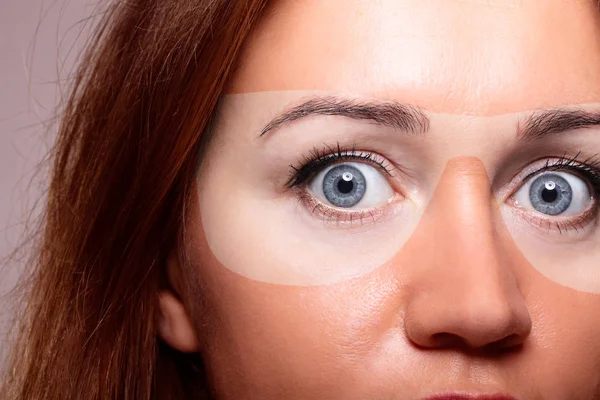 Donna Con Gravi Scottature Sotto Gli Occhiali Sole — Foto Stock
