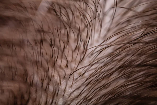 Macro Shot Thinning Hair Head — Stock Photo, Image