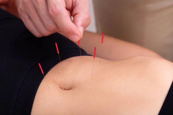 Close Doctor Hand Perform Medical Professional Acupuncture Treatment Beauty Spa — Stock Photo, Image