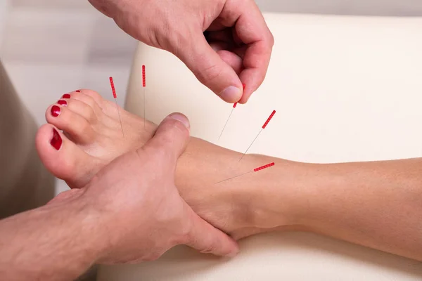 在足部皮肤植入细针进行针灸治疗的妇女 — 图库照片