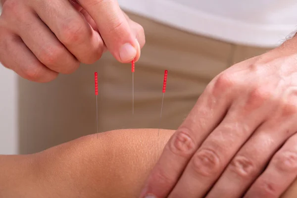 Primer Plano Mano Del Acupunturista Pinchando Agujas Acupuntura Rodilla Persona — Foto de Stock