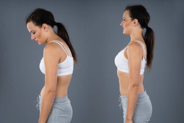 Woman With Lordosis And Normal Curvature Against Gray Background clipart