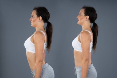 Lordosis 'li Kadın ve Gri Geçmişe Karşı Normal Eğrilik