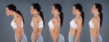 İleri Kafalı Kadın, Lordosis, Kyphosis, Geri Sallan ve Gri Geçmişe Karşı Normal Eğrilik
