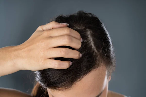 Young Woman Scratching Her Itchy Head Scalp — Stock Photo, Image